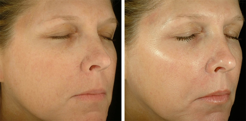 Obagi Blue Peel Radiance - The No Downtime Peel